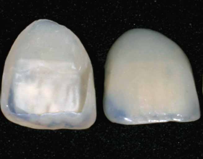Featured image for Unlock Your Best Smile: An Introduction to Porcelain Veneers