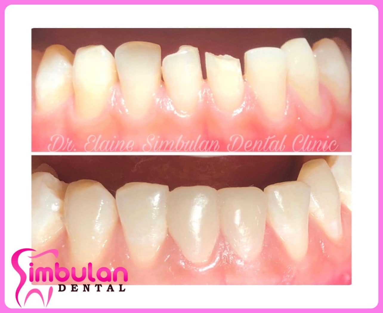 Featured image for The Durability of Porcelain Veneers – What You Need to Know