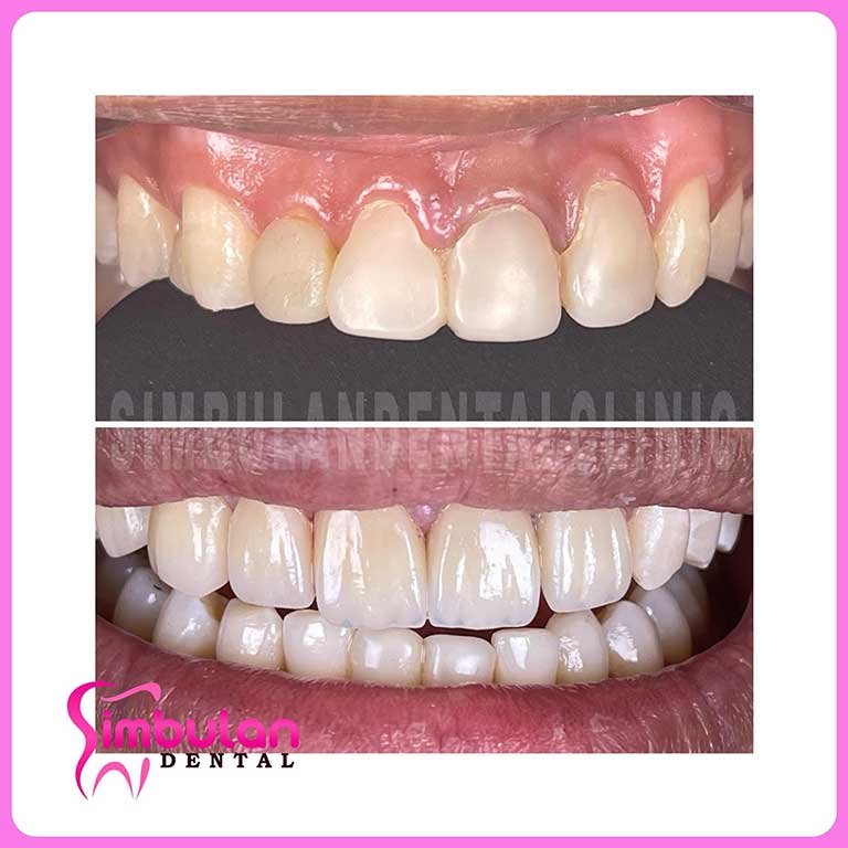 Featured image for The Veneer Application Process