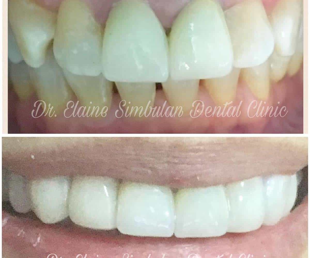 Prosthodontics Case #1