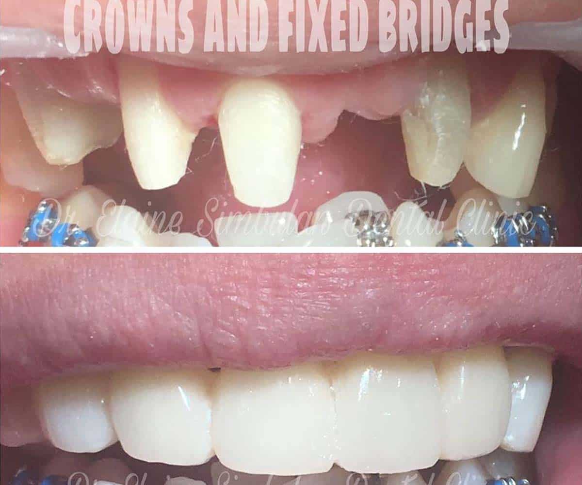 Prosthodontics Case #2