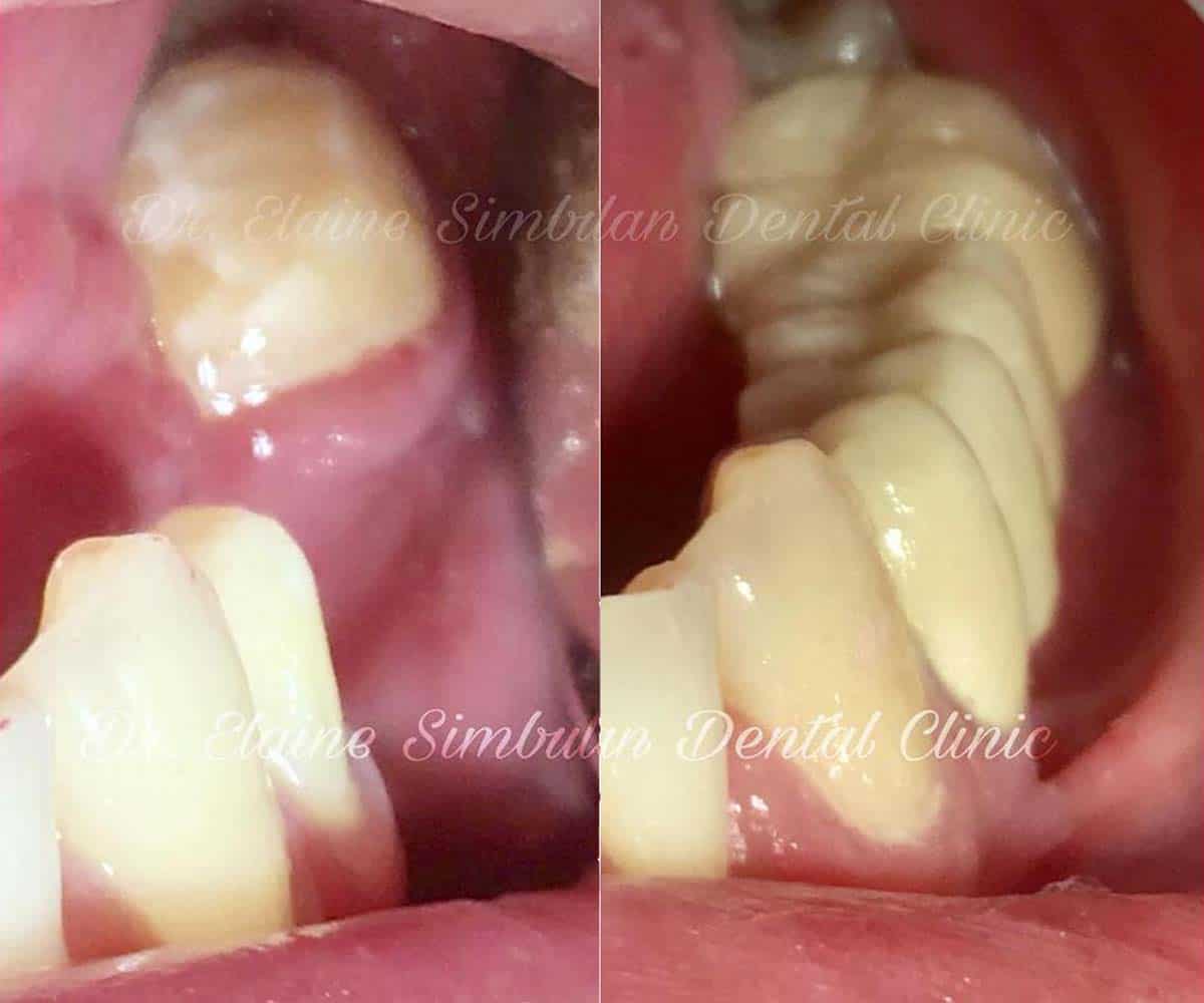 Prosthodontics Case #3