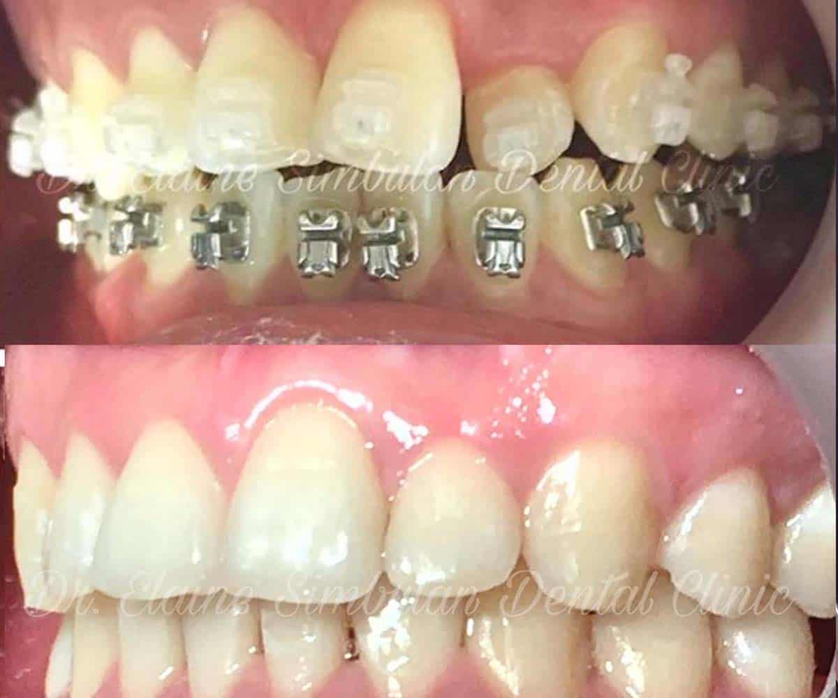 Orthodontics Case #1