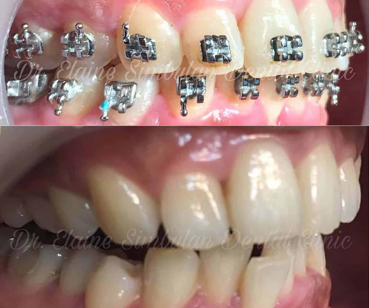 Orthodontics Case #2