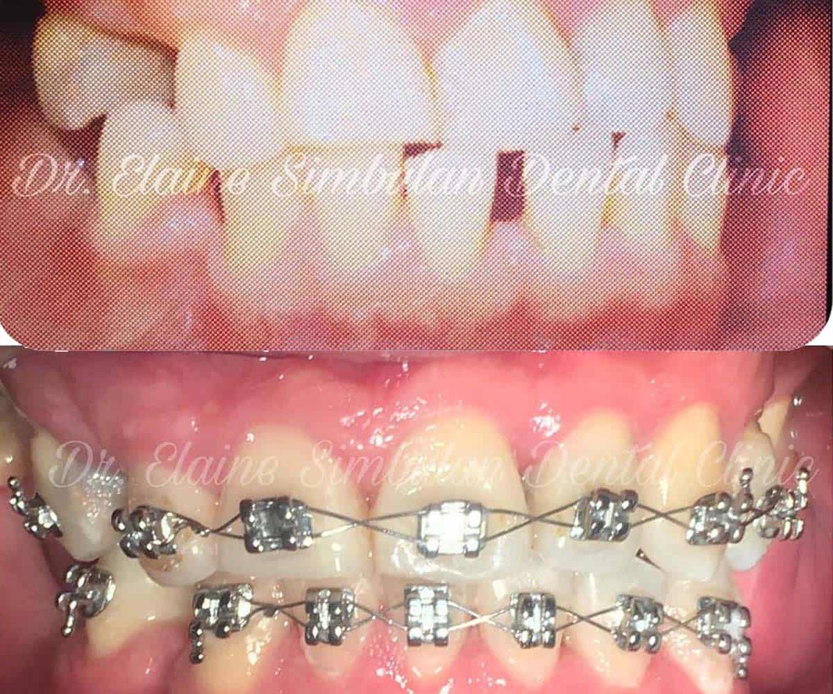 Orthodontics Case #3