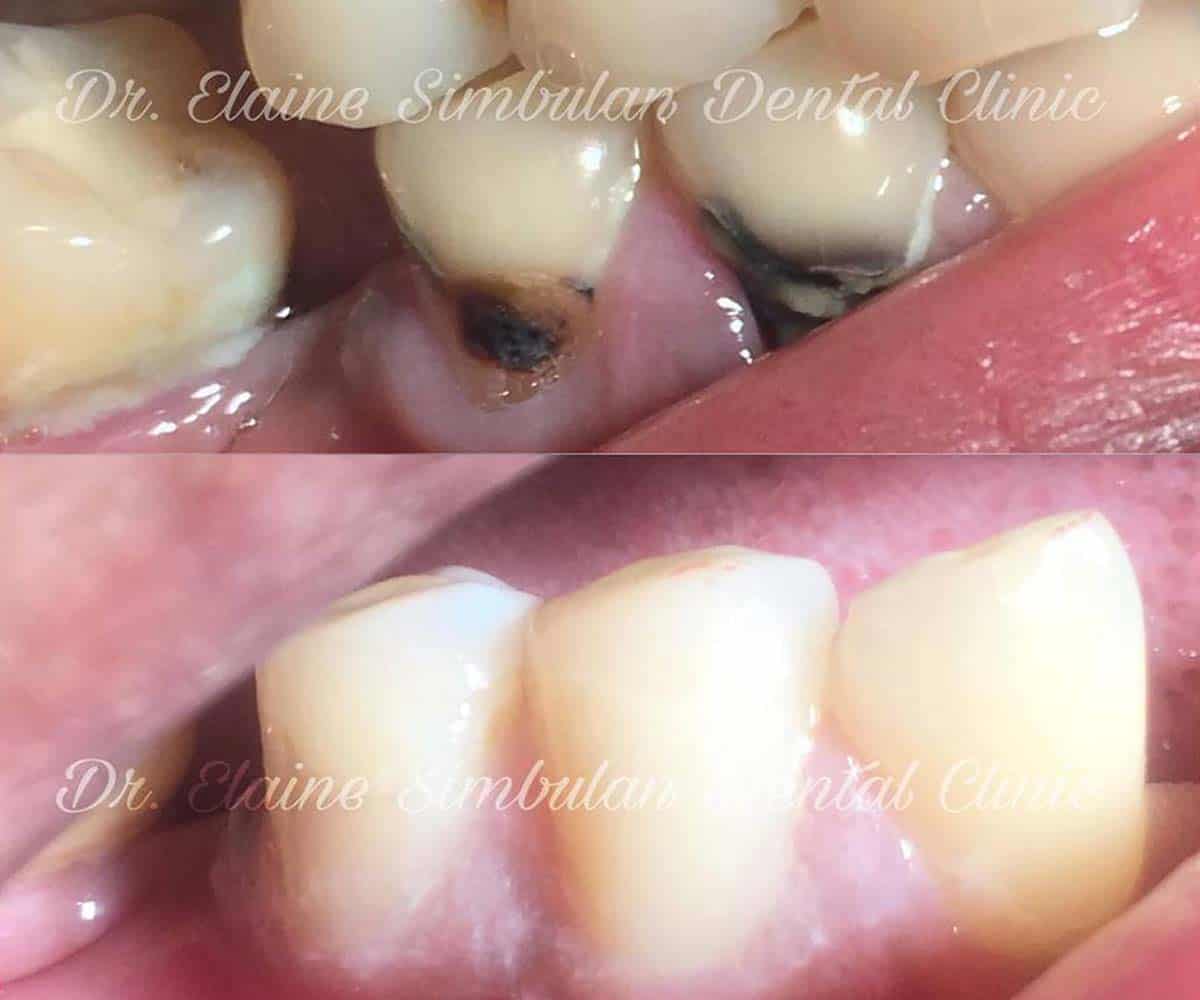 Restorative Case #1