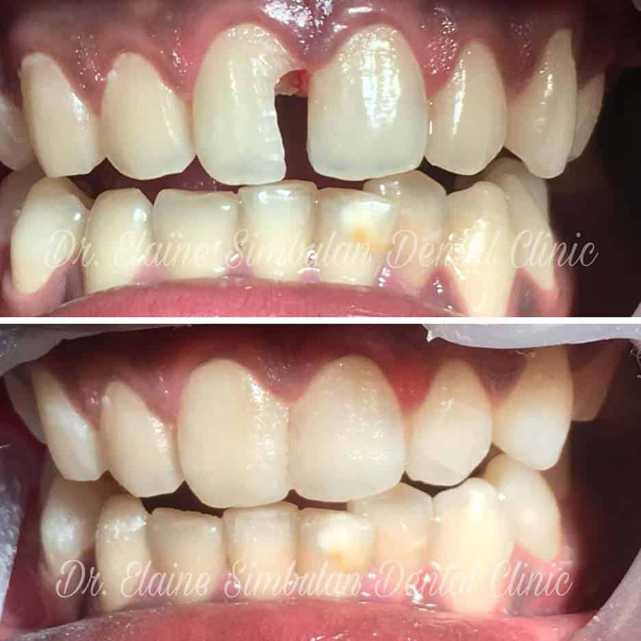 Restorative Case #2