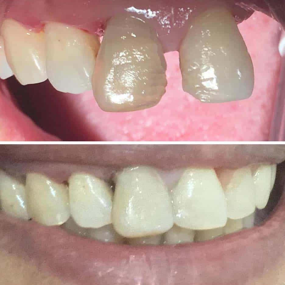 Restorative Case #3