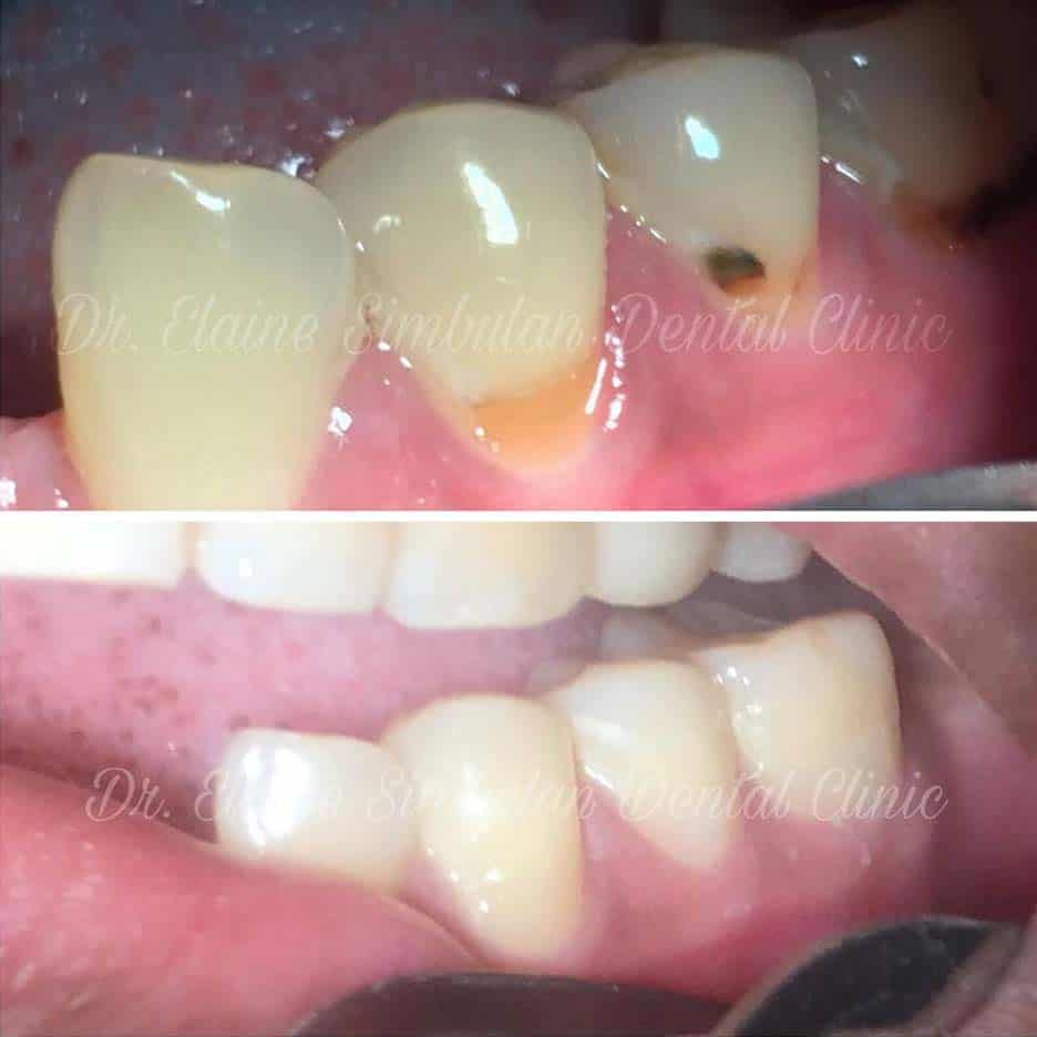 Restorative Case #4