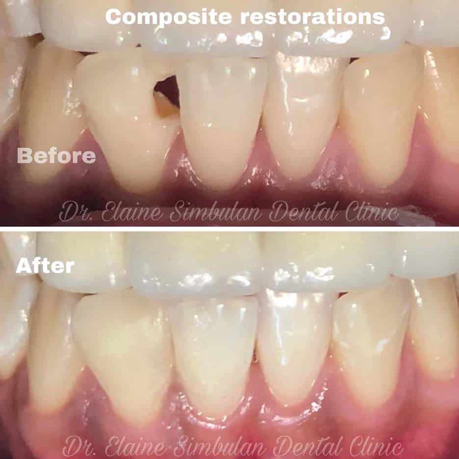Restorative Case #5