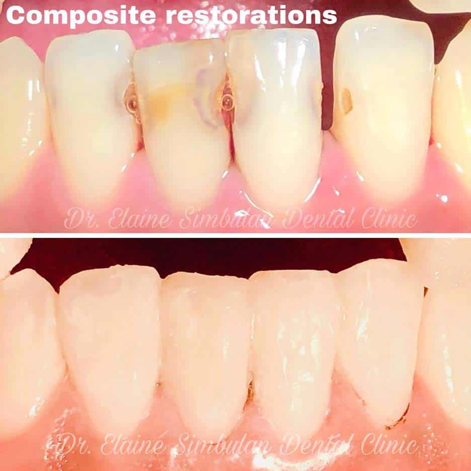 Restorative Case #6
