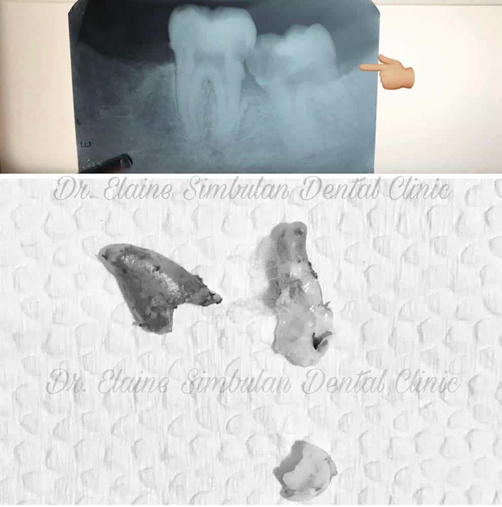 Oral Surgery Case #1