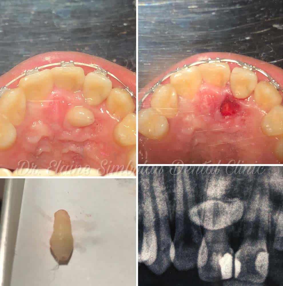 Oral Surgery Case #2