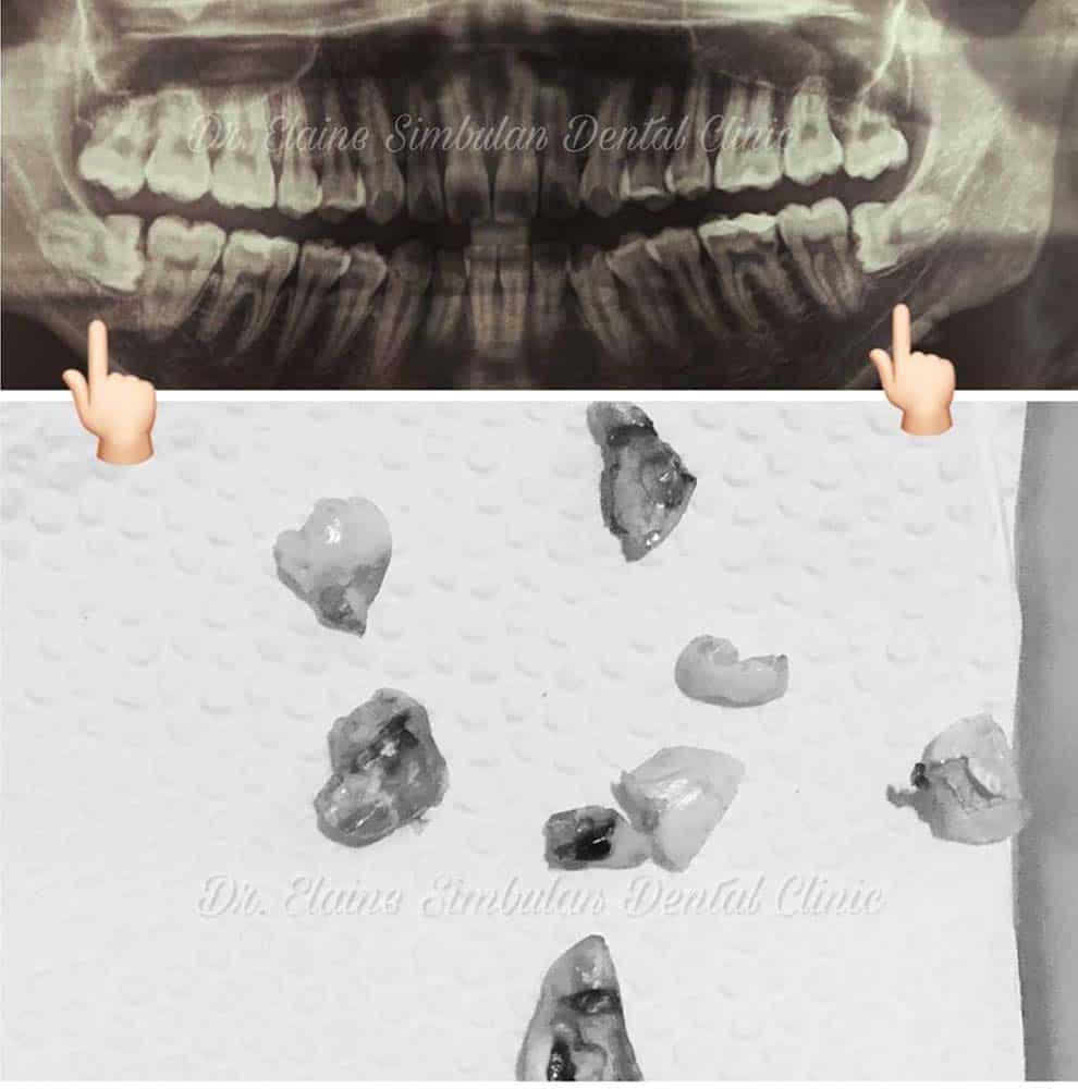 Oral Surgery Case #3