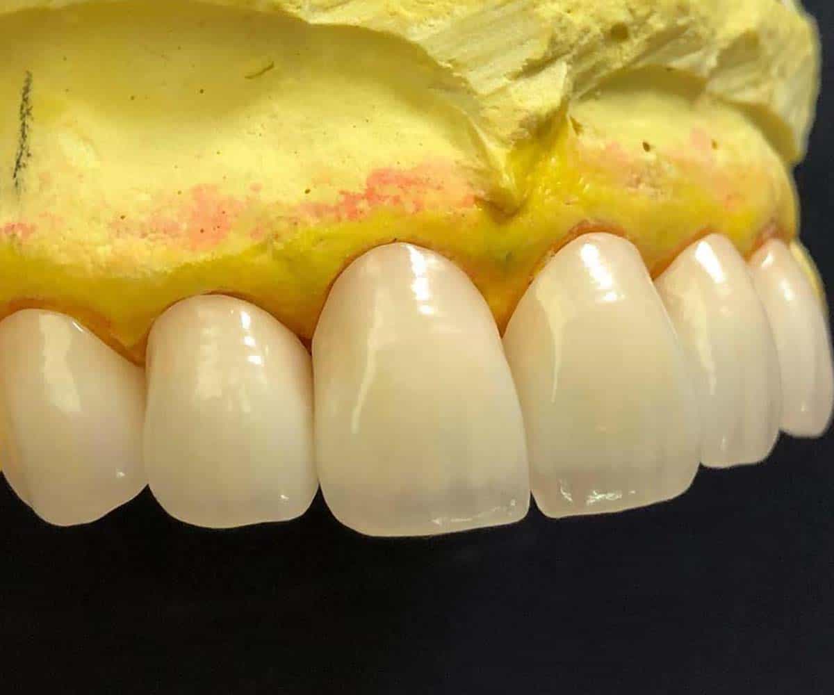Porcelain Veneer #2