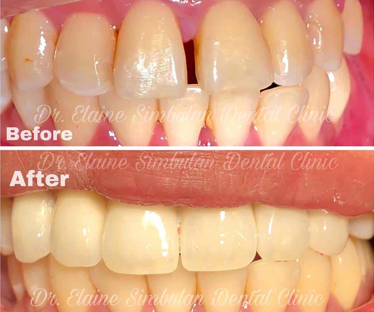 Porcelain Veneer #3