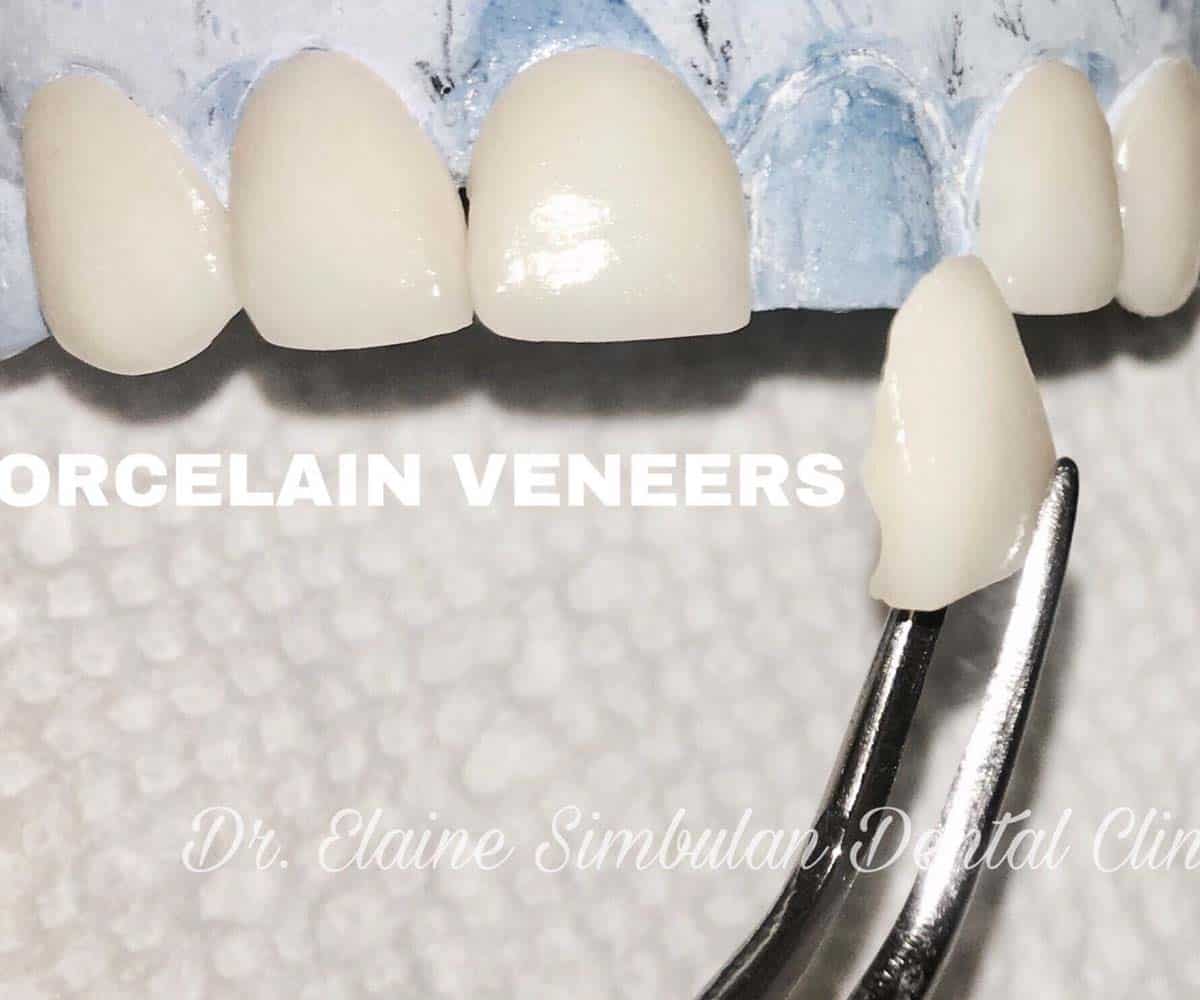 Porcelain Veneer #4