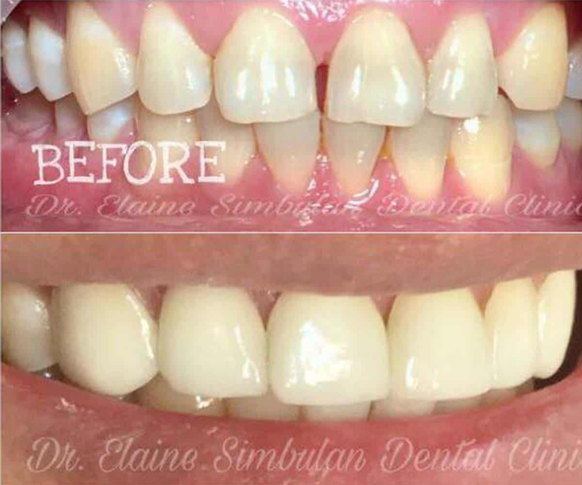 Porcelain Veneer #5