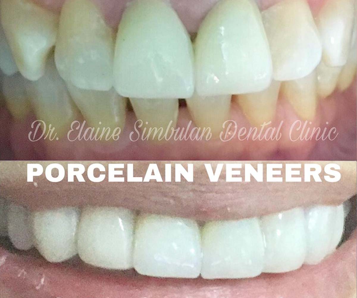 Porcelain Veneer #6