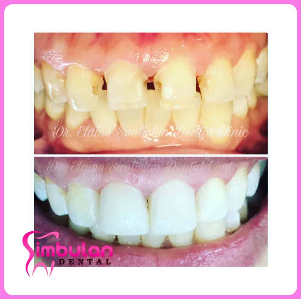 Veneers-2023 (1)