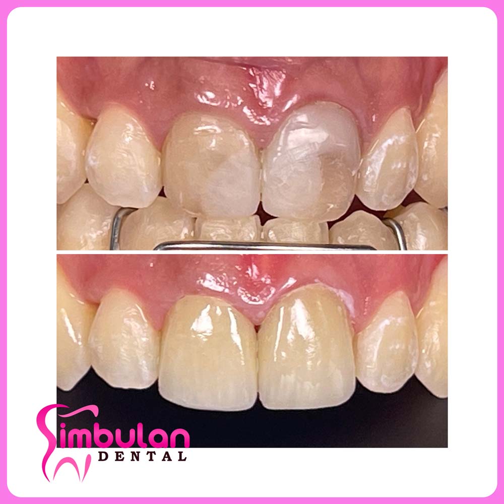 Veneers-2023 (10)