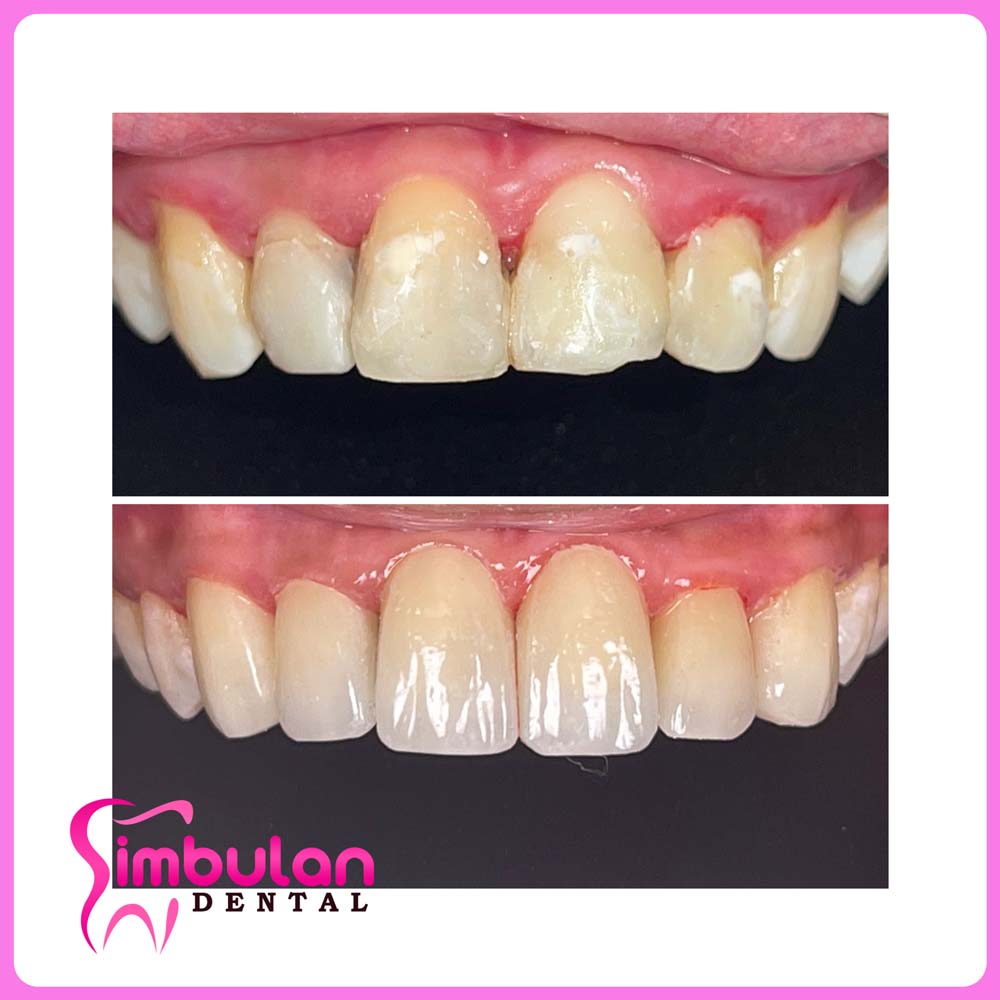 Veneers-2023 (11)