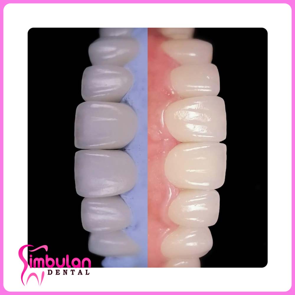 Veneers-2023 (2)