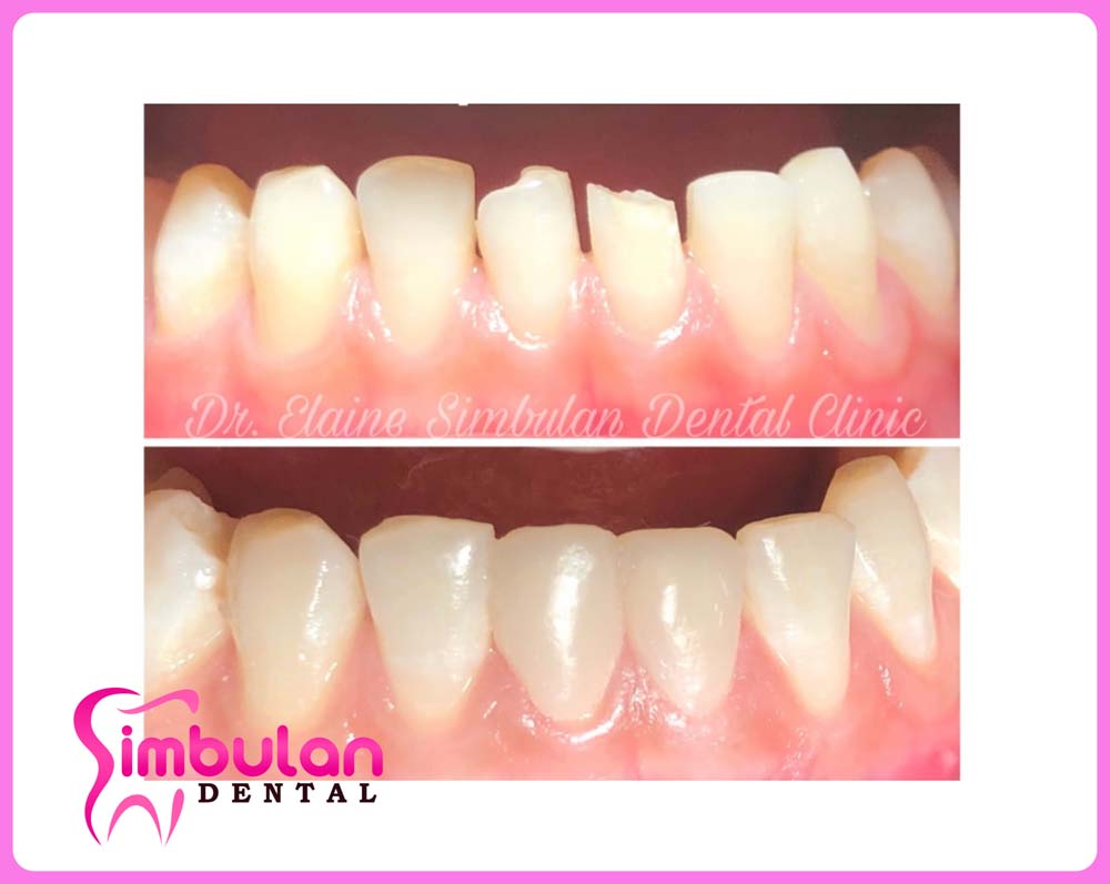 Veneers-2023 (3)