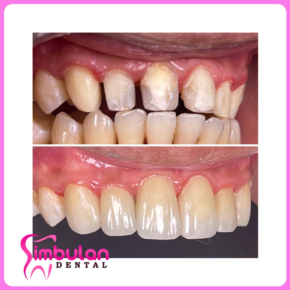 Veneers-2023 (4)