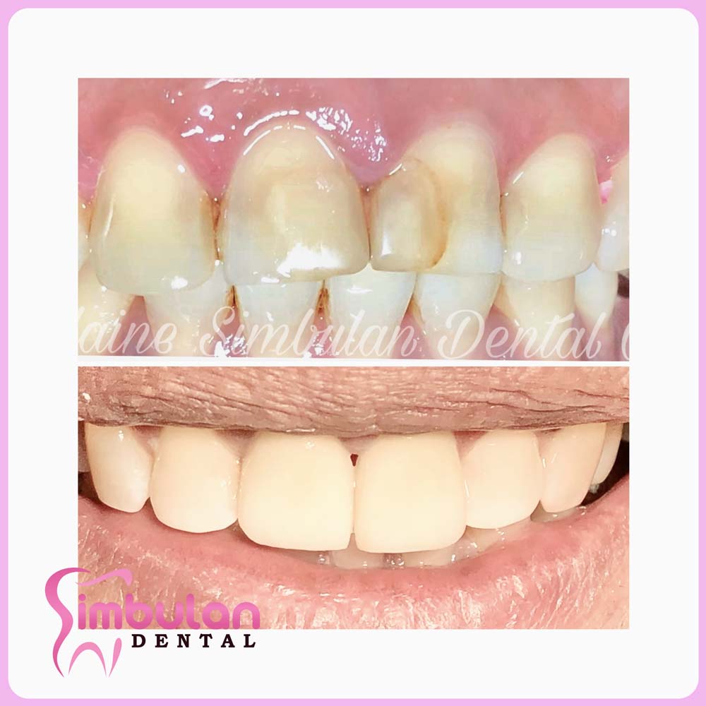 Veneers-2023 (5)
