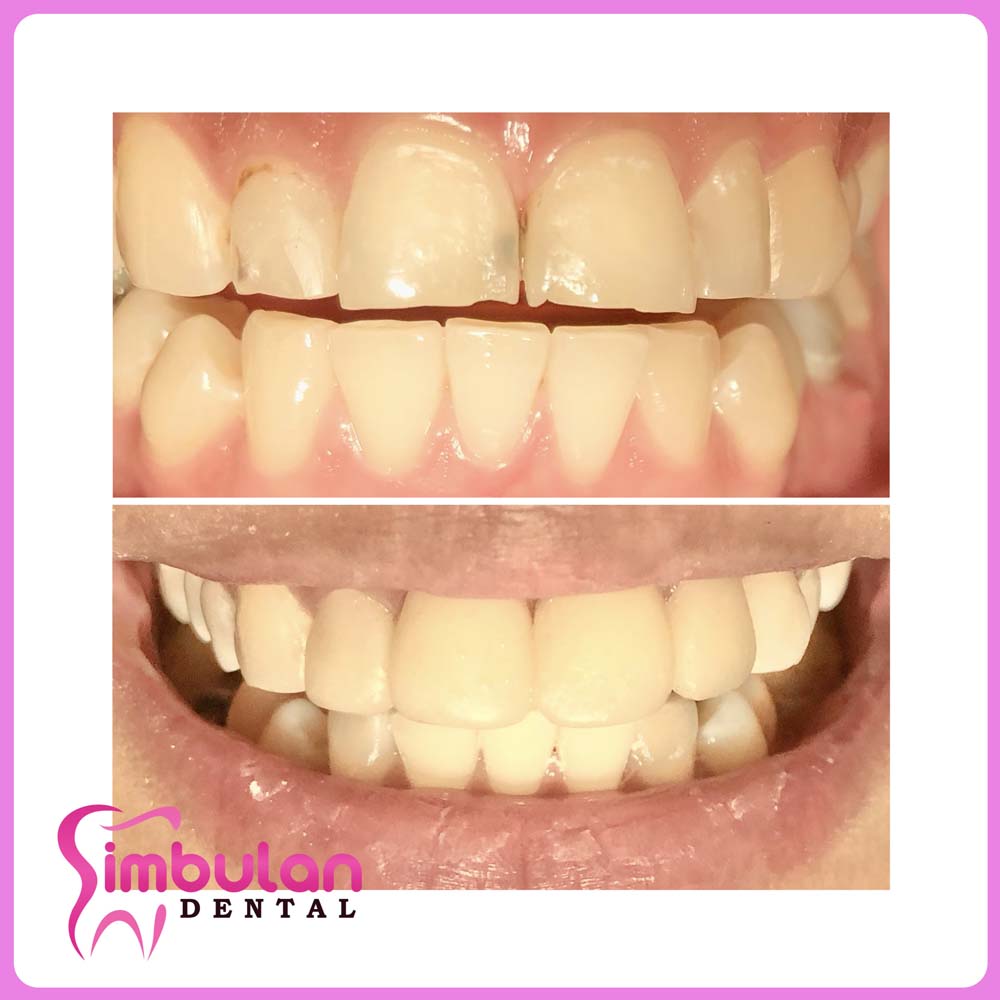 Veneers-2023 (6)
