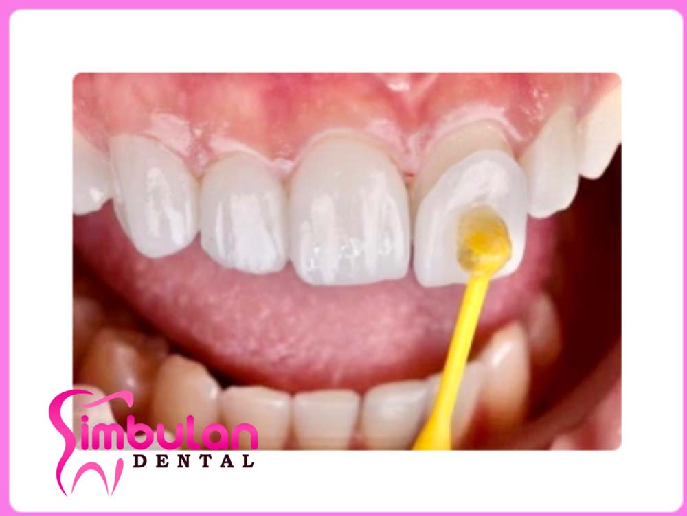 Veneers-2023 (7)