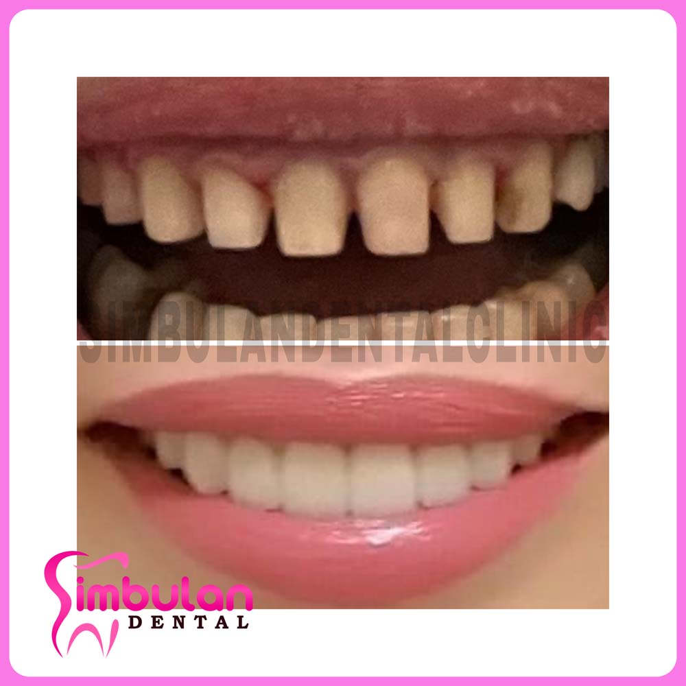 Veneers-2023 (8)