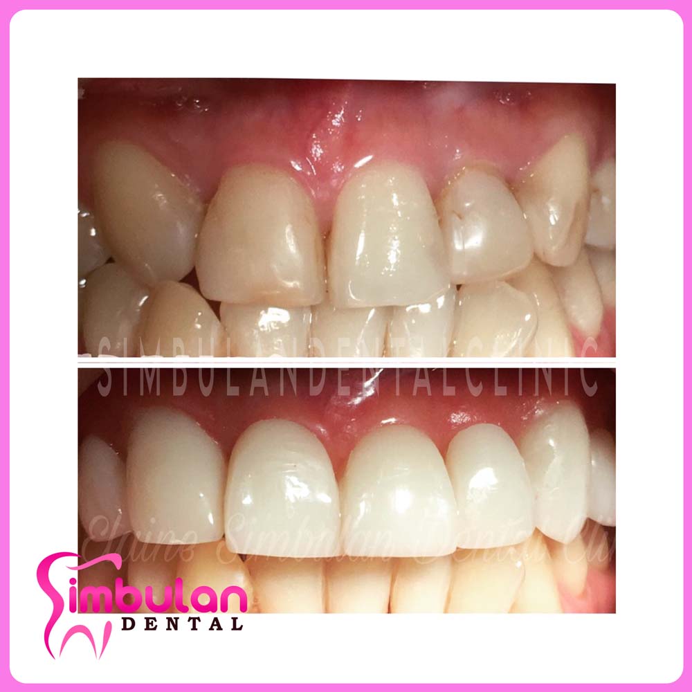 Veneers-2023 (9)