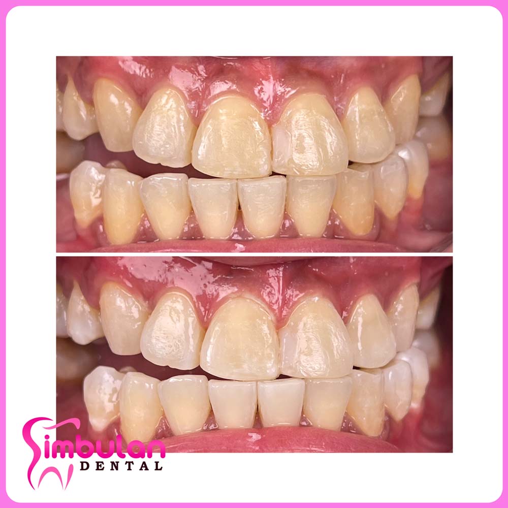 Whitening-2023 (1)