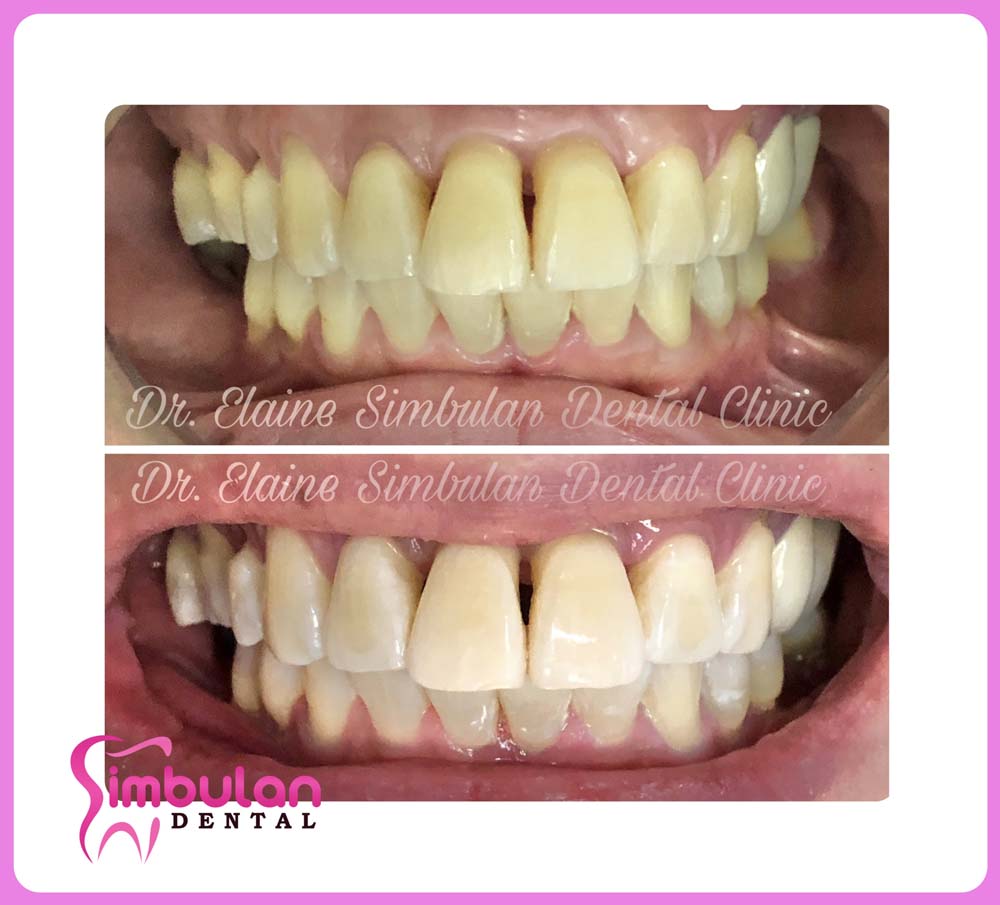 Whitening-2023 (10)