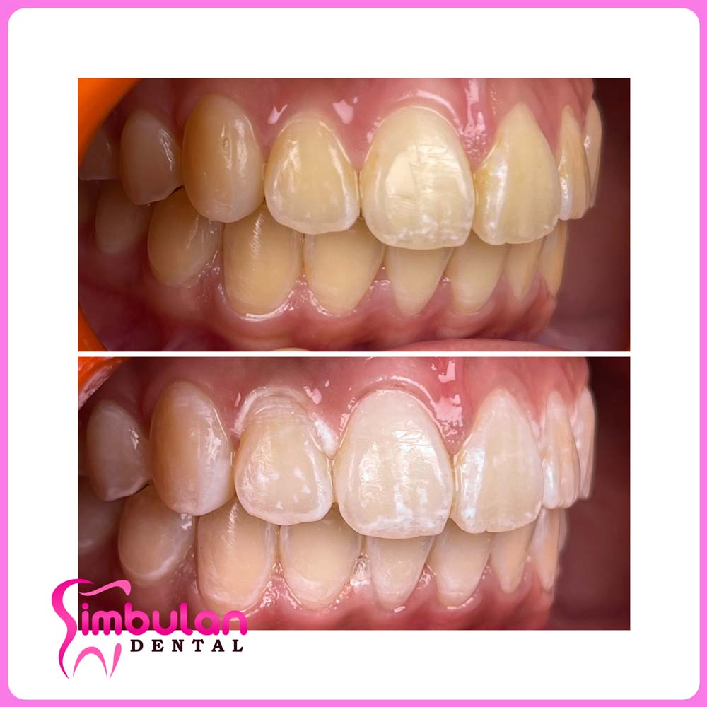 Whitening-2023 (2)