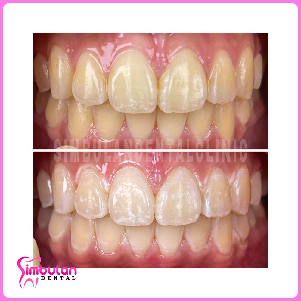 Whitening-2023 (3)