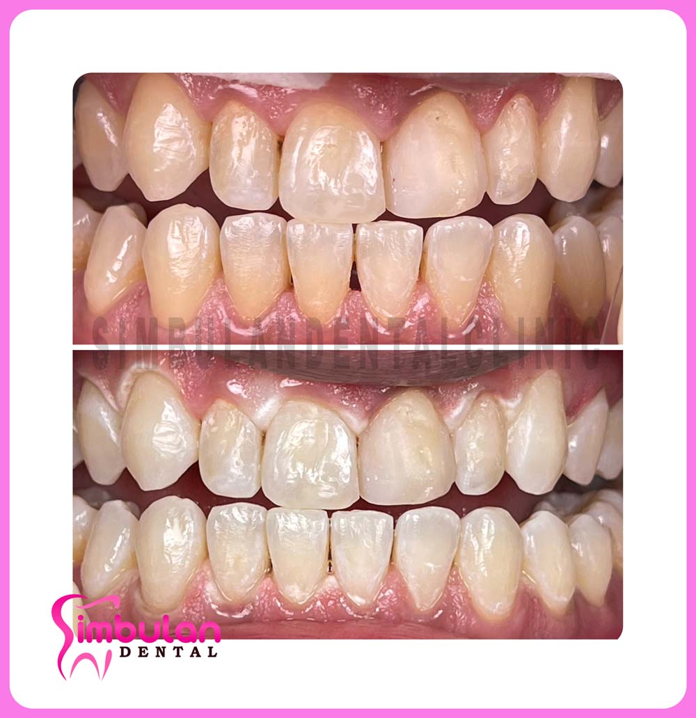 Whitening-2023 (4)