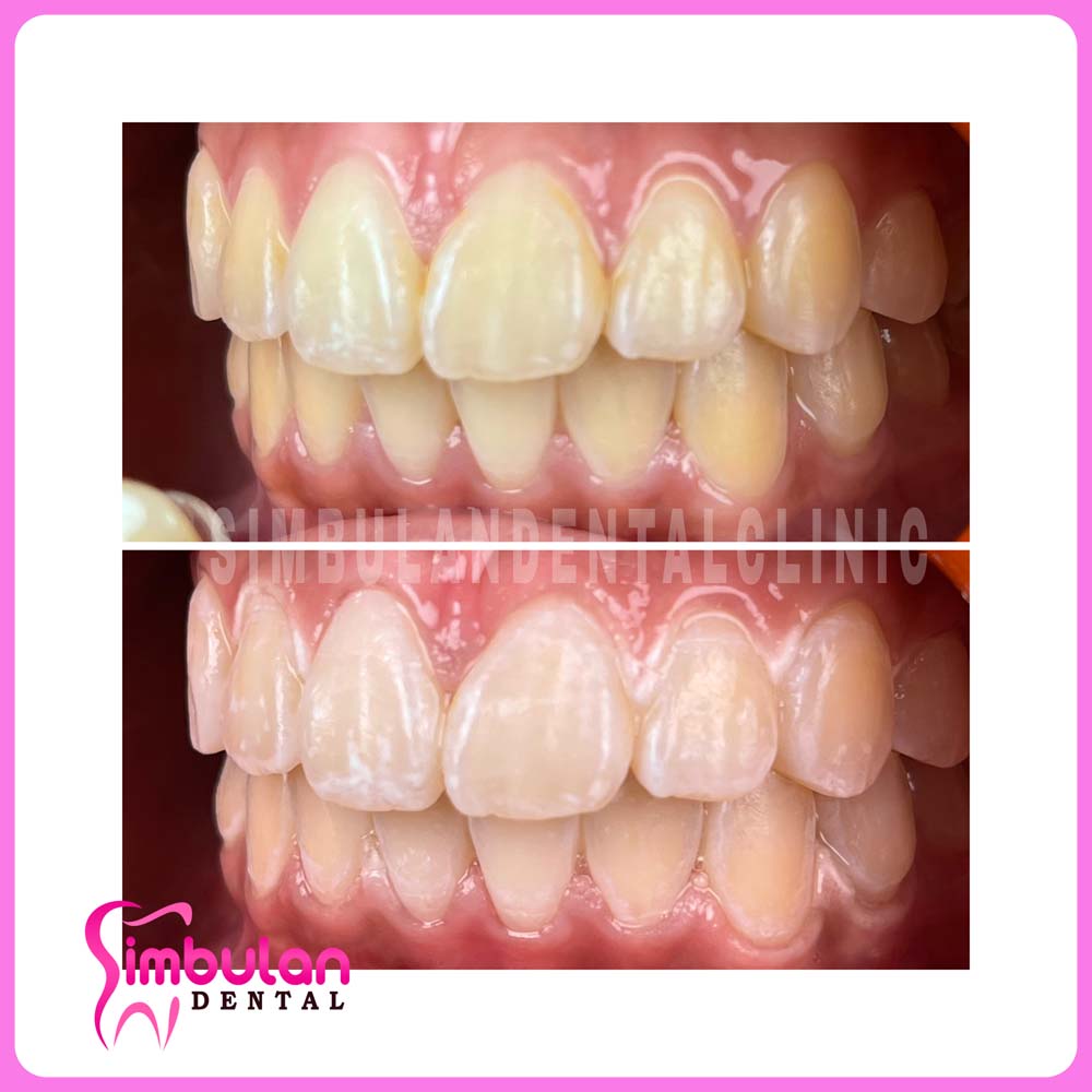 Whitening-2023 (5)