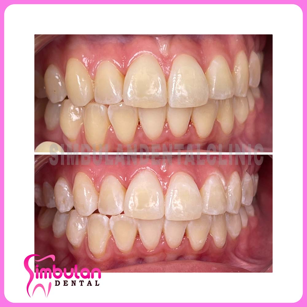 Whitening-2023 (6)