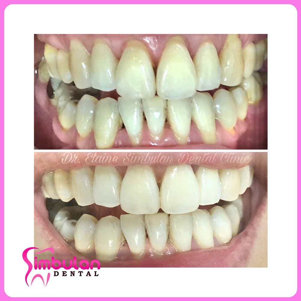 Whitening-2023 (7)