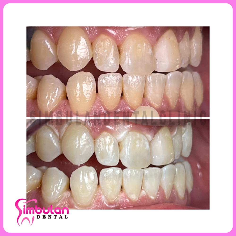 Whitening-2023 (8)